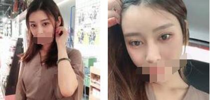 太原歐美蓮整形醫(yī)院丁曉峰醫(yī)生做雙眼皮怎么樣？丁曉峰雙眼皮手術(shù)案例分享