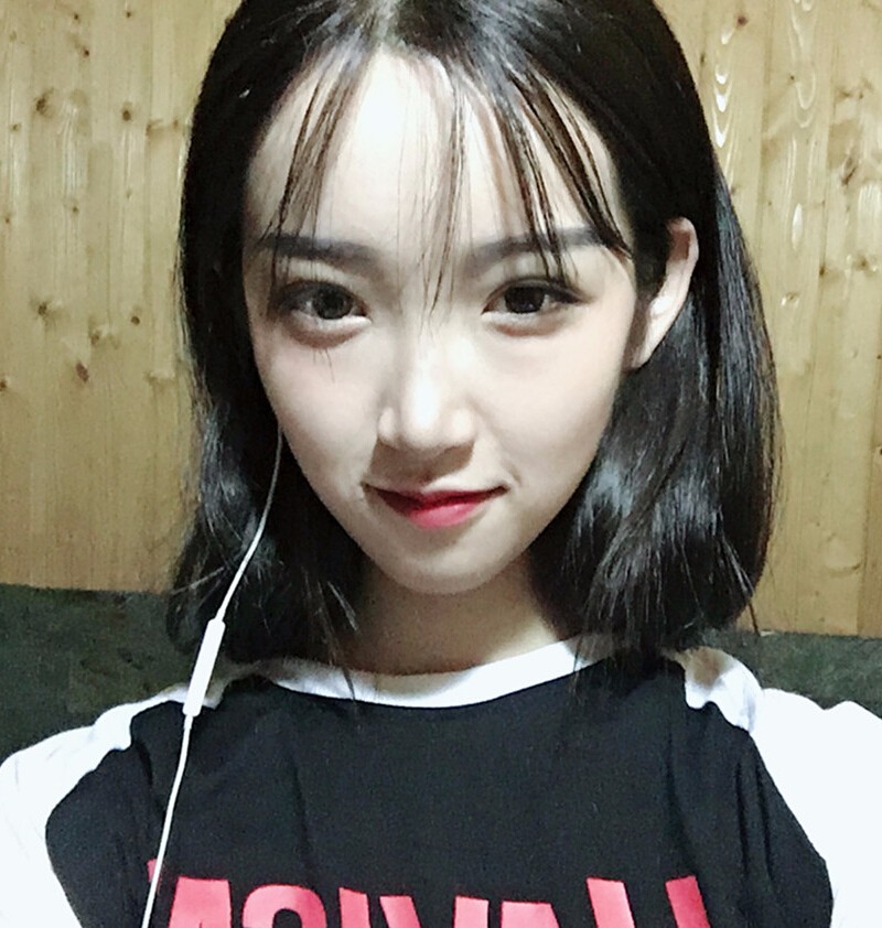 重慶威妮醫(yī)療整形醫(yī)生伊莉做切開雙眼皮+開眼角真人案例效果對(duì)比圖