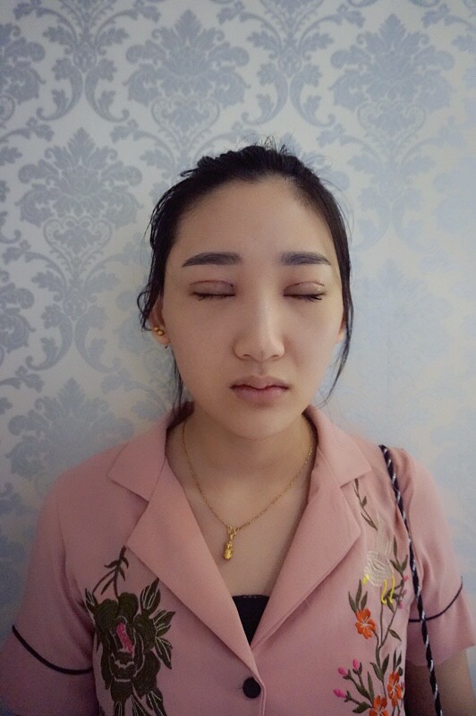 武漢中翰整形外科醫(yī)院沈磊醫(yī)生做切開(kāi)雙眼皮怎么樣？附沈磊切開(kāi)雙眼皮案例