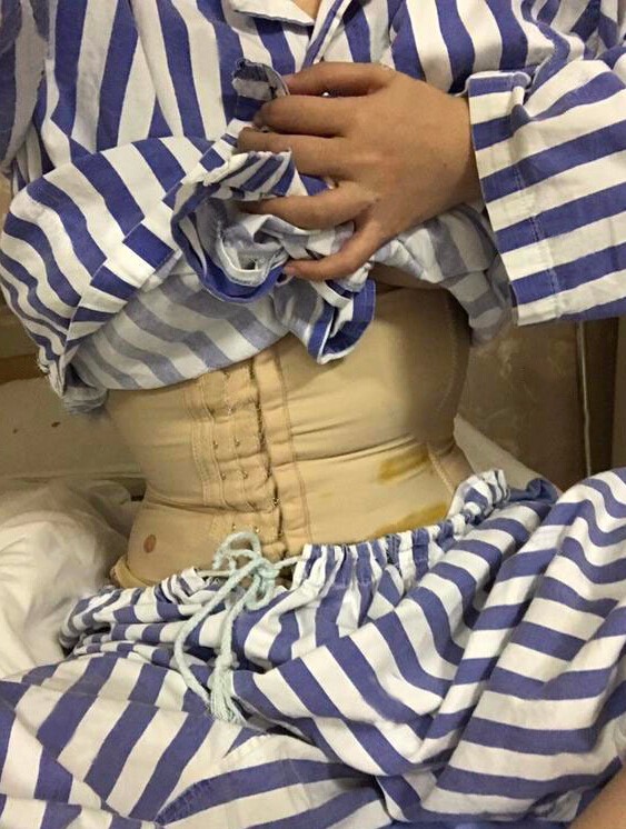 長沙亞韓醫(yī)學整形醫(yī)生米勒做腰腹吸脂效果怎么樣？米勒腰腹吸脂案例