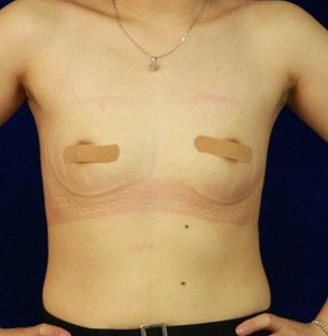 珠海萊茵醫(yī)療美容醫(yī)院崔俊溶醫(yī)生做自體脂肪隆胸效果怎么樣？附自體脂肪隆胸案例