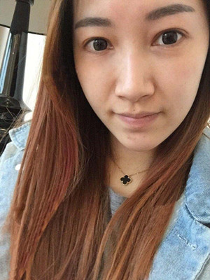 重慶五洲女子醫(yī)院整形美容中心做光子嫩膚怎么樣？淡明斌醫(yī)生光子嫩膚案例