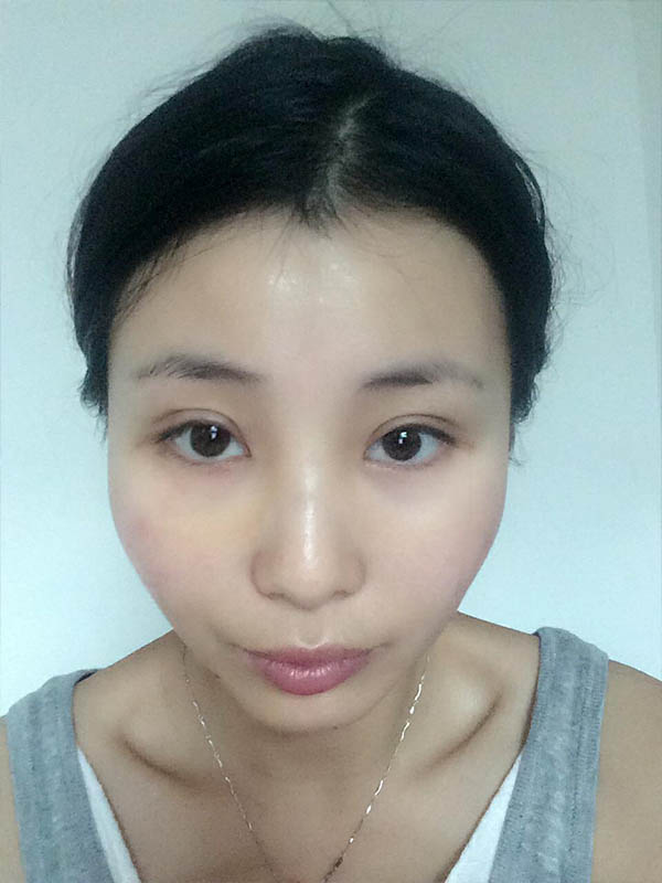 桂林新華醫(yī)療美容醫(yī)生李新華做雙眼皮手術(shù)怎么樣？李新華雙眼皮手術(shù)案例