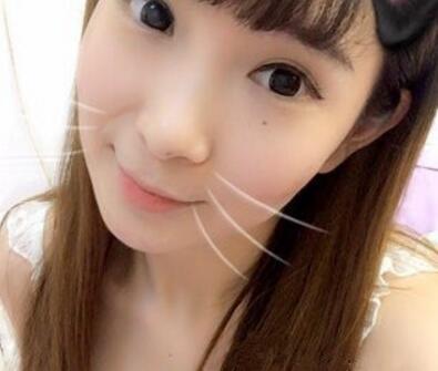 武漢中翰整形外科醫(yī)院陳志鵬醫(yī)生做雙眼皮修復效果怎么樣？附雙眼皮修復案例