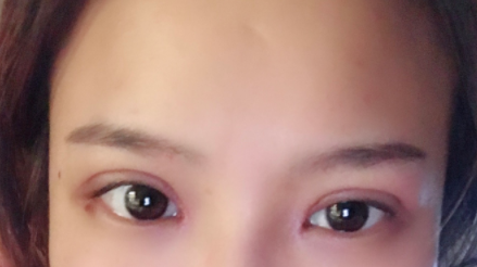 長春麥西美嘉整形醫(yī)生王圣博做雙眼皮手術效果怎么樣？附雙眼皮案例