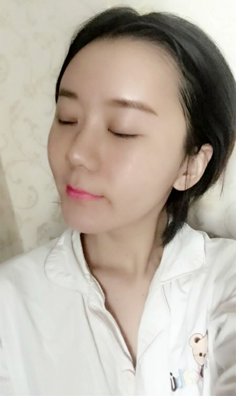 沈陽友誼整形美容醫(yī)院金顕哲醫(yī)生做自體脂肪填充臉部+V-LINE瓜子臉手術(shù)案例效果圖 沈陽友誼整形美容醫(yī)院金顕哲醫(yī)生做自體脂肪填充臉部+V-LINE瓜子臉手術(shù)案例效果圖