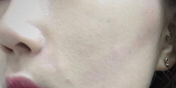 信陽東方藝美容醫(yī)院劉力萌做玻尿酸去法令紋效果怎么樣？附案例效果對比圖