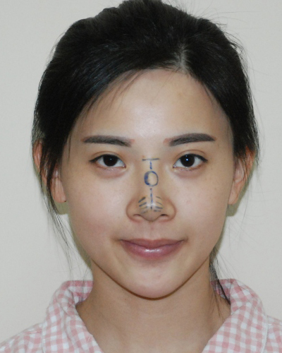 襄陽維多利亞整形醫(yī)院安邰晥醫(yī)生做鼻綜合整形怎么樣？附鼻綜合整形案例