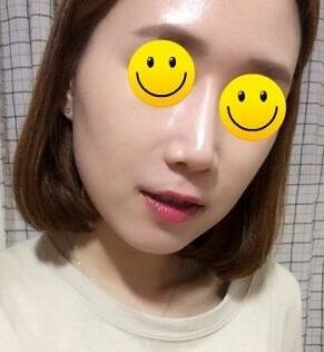 信陽東方藝美容醫(yī)院劉力萌做玻尿酸去法令紋效果怎么樣？附案例效果對比圖