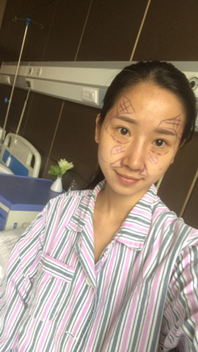 湛江澳泰整形醫(yī)院彭鑫醫(yī)生做自體脂肪豐蘋果肌+太陽穴案例效果對(duì)比圖