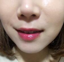 信陽東方藝美容醫(yī)院劉力萌做玻尿酸去法令紋效果怎么樣？附案例效果對比圖