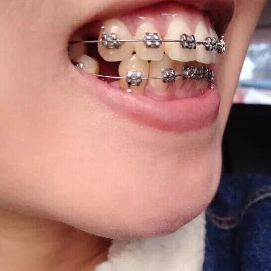 重慶嘉悅口腔醫(yī)院周繼祥醫(yī)生做金屬托槽矯正效果怎么樣？附案例效果對比圖