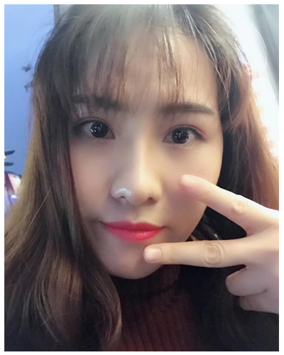 營(yíng)口臻美醫(yī)療整形醫(yī)生閆迎軍做雙眼皮效果怎么樣？附雙眼皮案例對(duì)比圖