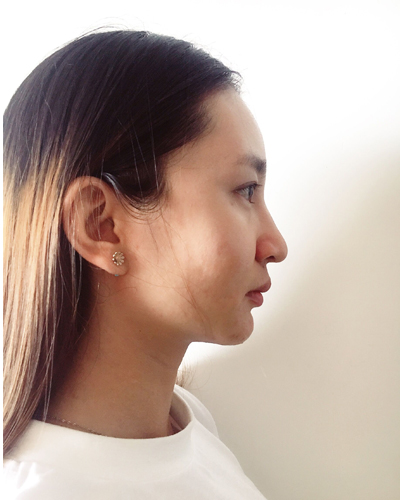 武漢維納斯整形醫(yī)院趙瑾醫(yī)生做玻尿酸墊下巴怎么樣？附玻尿酸墊下巴案例