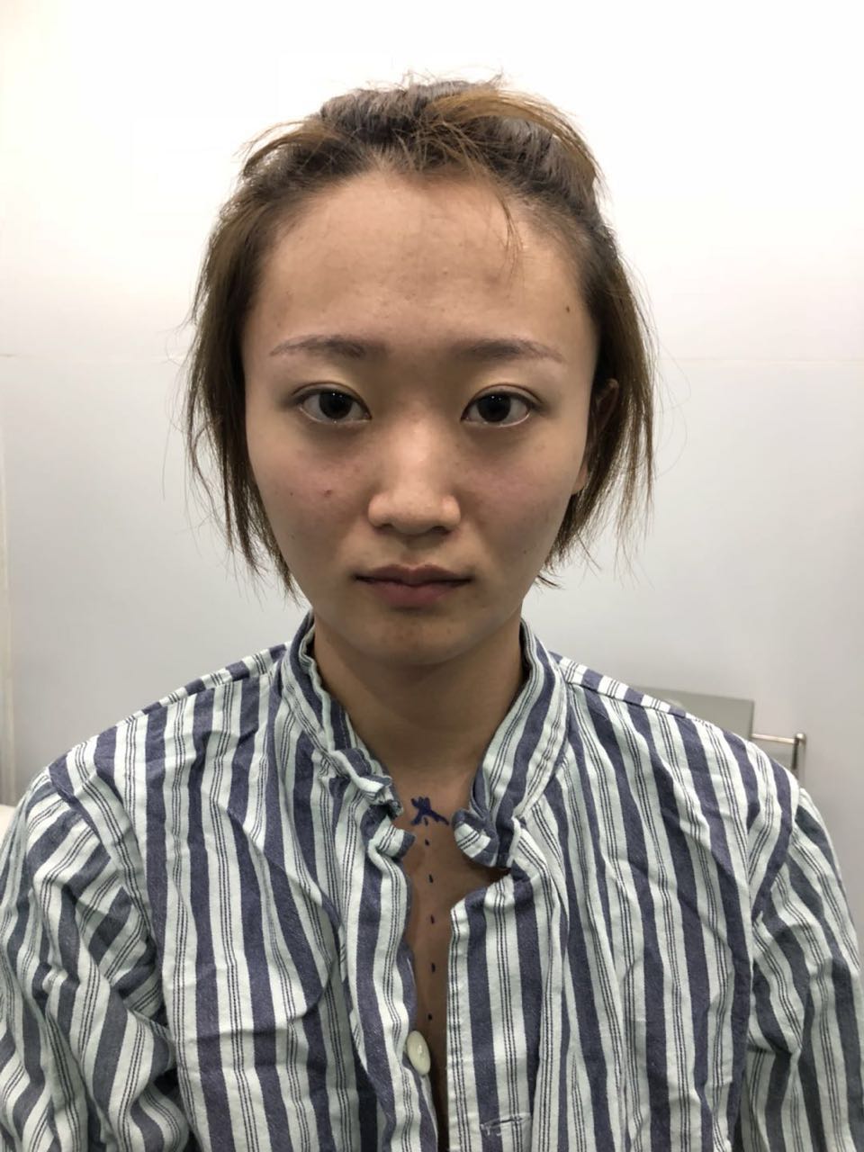 杭州迪美整形常德成醫(yī)生做鼻綜合整形技術(shù)怎么樣？附鼻綜合整形案例