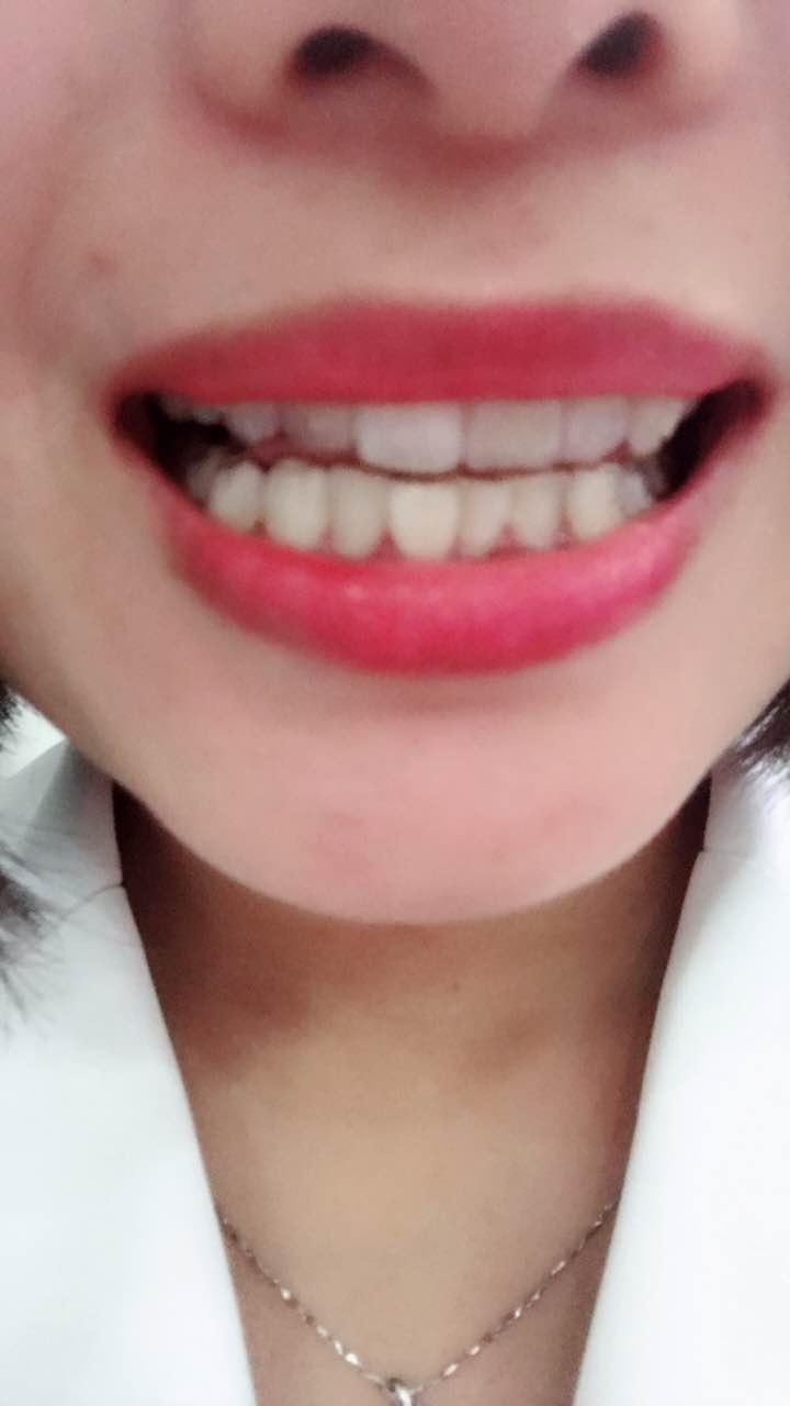 鄭州壹加壹整形醫(yī)院楊永利醫(yī)生做牙齒隱形矯正怎么樣？附牙齒隱形矯正案例