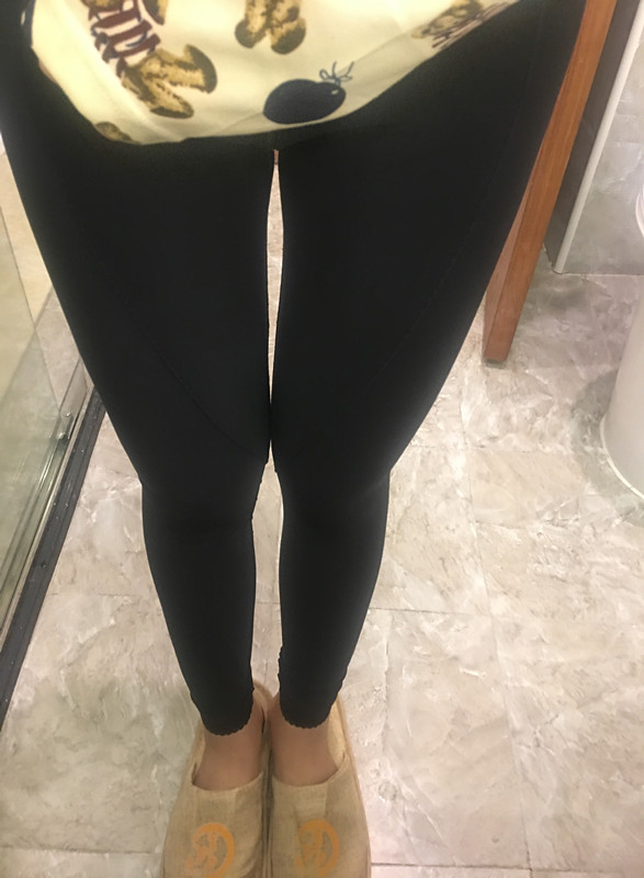 晉城鳳凰整形美容醫(yī)院宋發(fā)興醫(yī)生做大腿吸脂怎么樣？附大腿吸脂案例