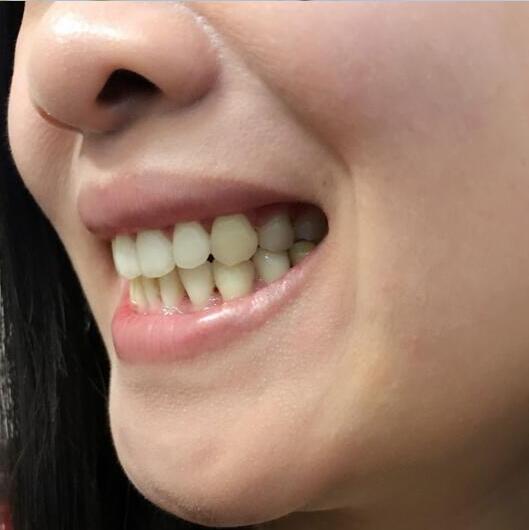 重慶嘉悅口腔醫(yī)院周繼祥醫(yī)生做金屬托槽矯正效果怎么樣？附案例效果對比圖