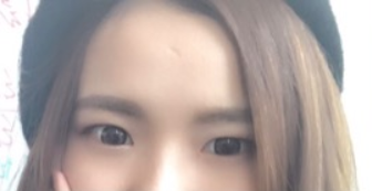 長春麥西美嘉整形醫(yī)生王圣博做雙眼皮手術效果怎么樣？附雙眼皮案例