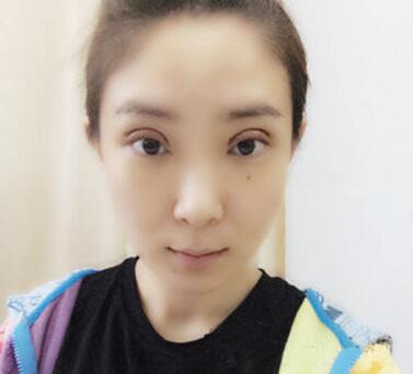 武漢中翰整形外科醫(yī)院陳志鵬醫(yī)生做雙眼皮修復效果怎么樣？附雙眼皮修復案例