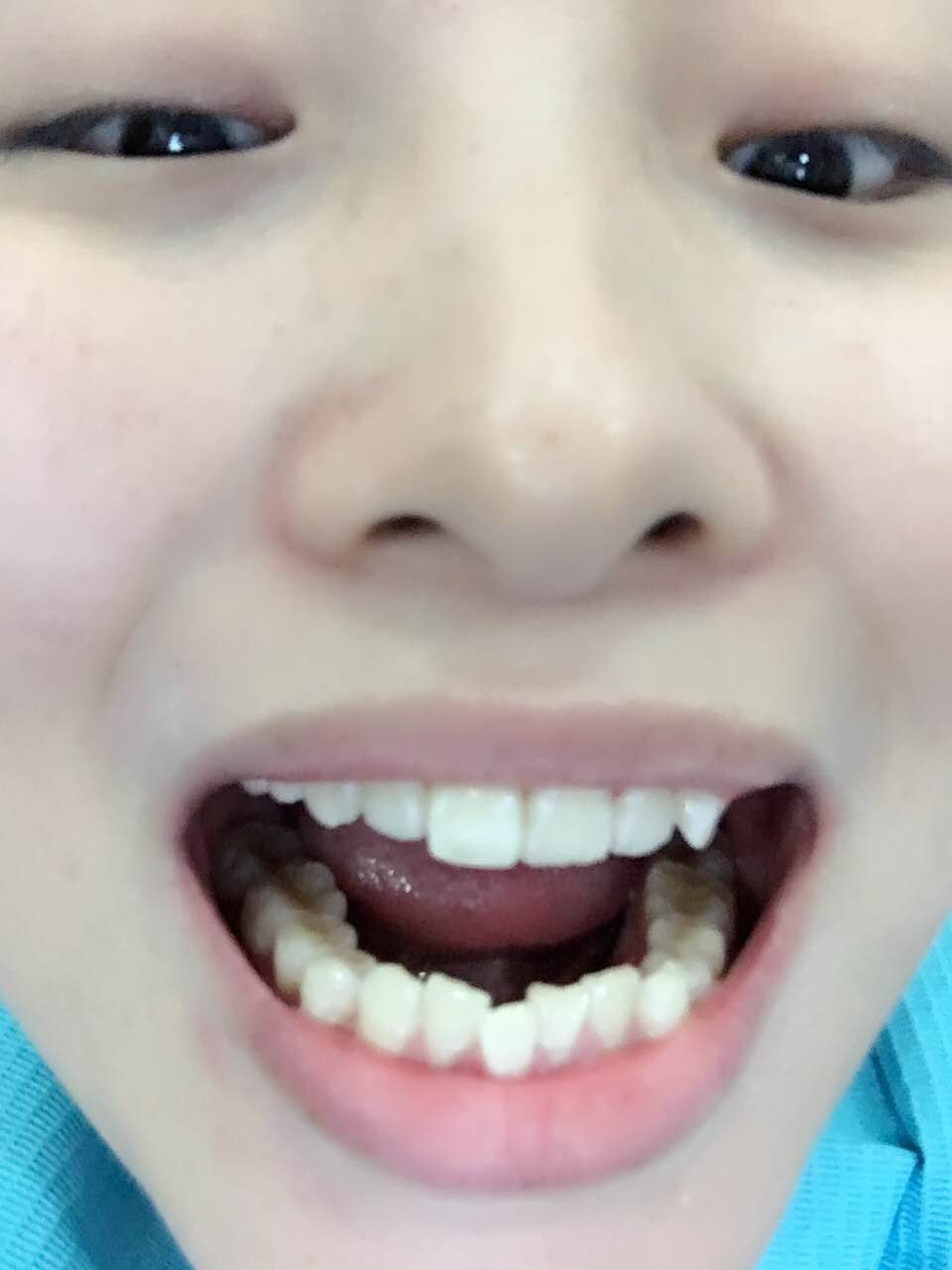 鄭州壹加壹整形醫(yī)院楊永利醫(yī)生做牙齒隱形矯正怎么樣？附牙齒隱形矯正案例