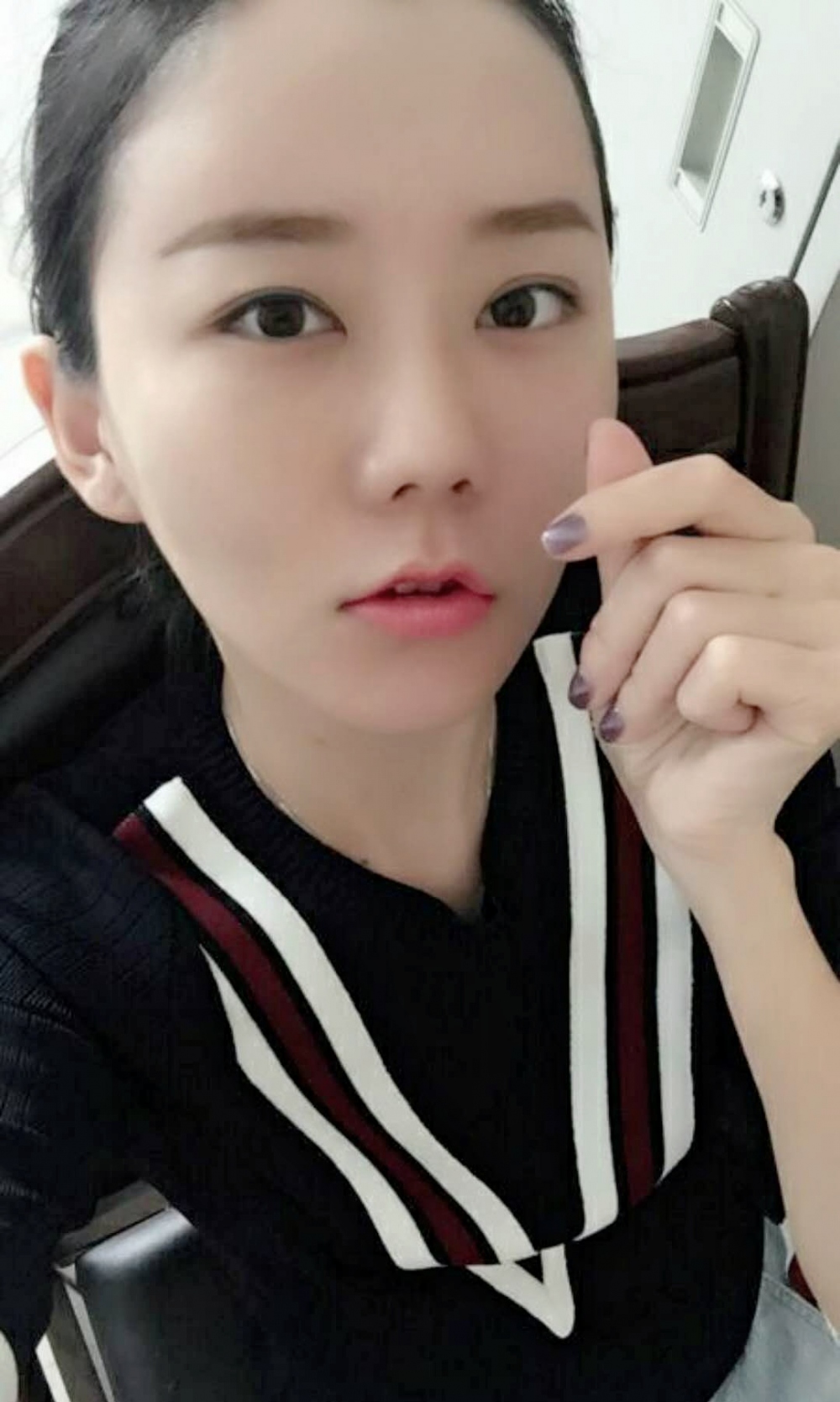 沈陽友誼整形美容醫(yī)院金顕哲醫(yī)生做自體脂肪填充臉部+V-LINE瓜子臉手術(shù)案例效果圖 沈陽友誼整形美容醫(yī)院金顕哲醫(yī)生做自體脂肪填充臉部+V-LINE瓜子臉手術(shù)案例效果圖