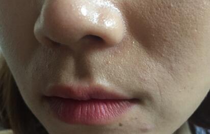 信陽東方藝美容醫(yī)院劉力萌做玻尿酸去法令紋效果怎么樣？附案例效果對比圖