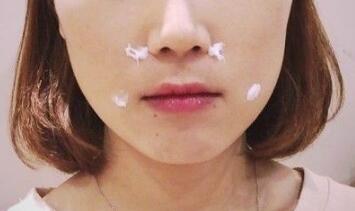 信陽東方藝美容醫(yī)院劉力萌做玻尿酸去法令紋效果怎么樣？附案例效果對比圖