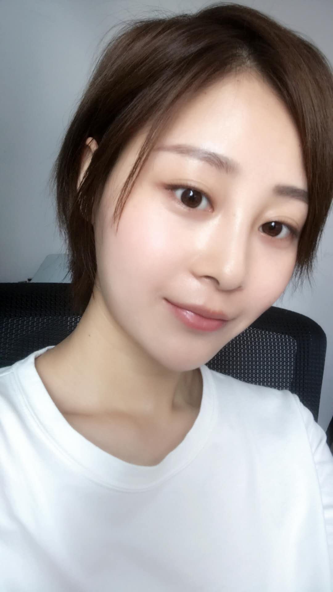 天津歐華威莎整形醫(yī)生姚玲做面部埋線提升效果怎么樣？附埋線提升案例