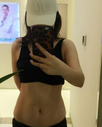 成都蜀尚蓉雅整形醫(yī)生張知華做腰腹吸脂效果怎么樣？附腰腹吸脂案例