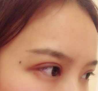 長春麥西美嘉整形醫(yī)生王圣博做雙眼皮手術效果怎么樣？附雙眼皮案例