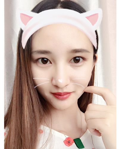 武漢維納斯整形醫(yī)院趙瑾醫(yī)生做玻尿酸墊下巴怎么樣？附玻尿酸墊下巴案例