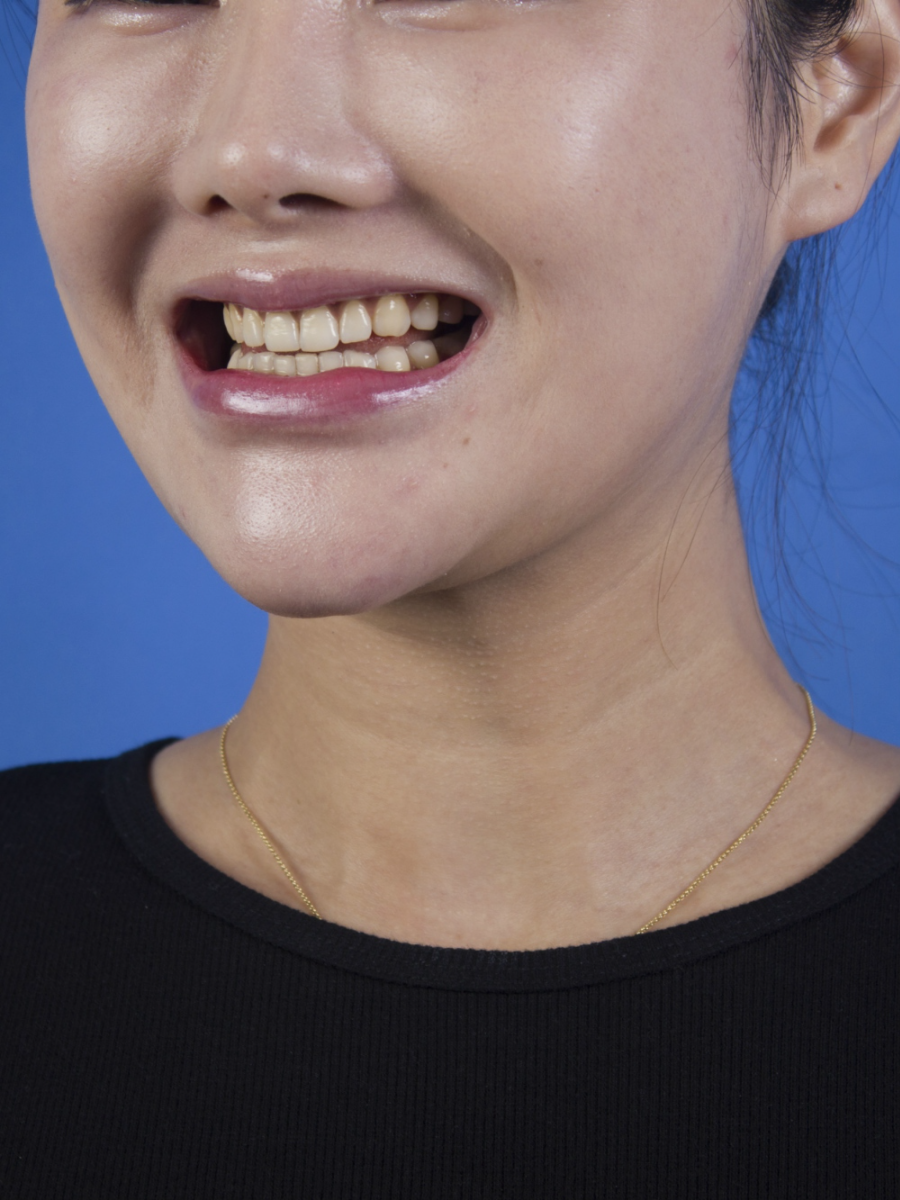 廣州柏德口腔蘭海龍醫(yī)生做瓷貼面效果怎么樣？廣州柏德口腔瓷貼面案例分享