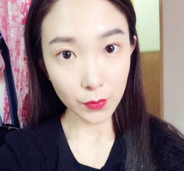 武漢中翰整形外科醫(yī)院陳志鵬醫(yī)生做雙眼皮修復效果怎么樣？附雙眼皮修復案例