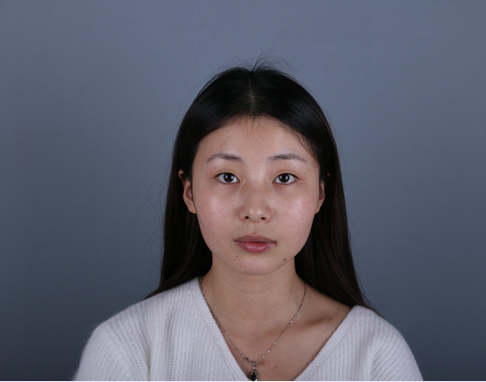 桂林新華醫(yī)療美容醫(yī)生李新華做雙眼皮手術(shù)怎么樣？李新華雙眼皮手術(shù)案例