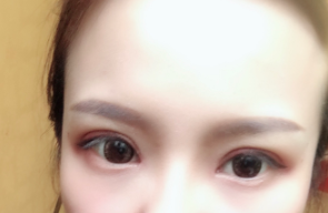 長春麥西美嘉整形醫(yī)生王圣博做雙眼皮手術(shù)效果怎么樣？附雙眼皮案例