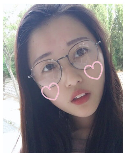 義烏傅氏口腔醫(yī)生朱雨晴做牙齒隱形矯正效果怎么樣？附牙齒隱形矯正案例