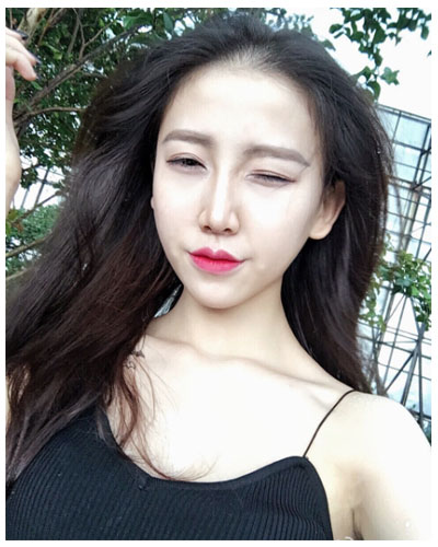 珠海海大整形美容外科黃發(fā)醫(yī)生做面部吸脂怎么樣？附面部吸脂案例