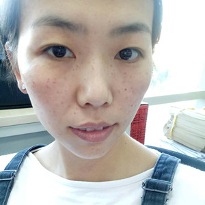 珠海蒂伊醫(yī)療整形醫(yī)生廖俊凱做激光祛斑效果怎么樣？附激光祛斑案例效果圖