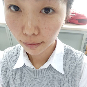 珠海蒂伊醫(yī)療整形醫(yī)生廖俊凱做激光祛斑效果怎么樣？附激光祛斑案例效果圖