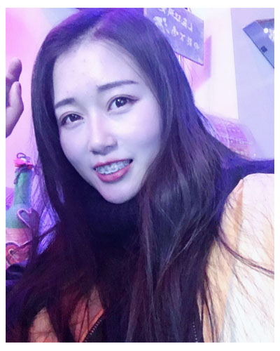 義烏傅氏口腔醫(yī)生朱雨晴做牙齒隱形矯正效果怎么樣？附牙齒隱形矯正案例