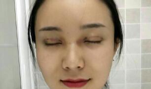 長沙微笑醫(yī)療整形醫(yī)生段雙軍做切開雙眼皮+開內(nèi)眼角效果怎么樣？附案例