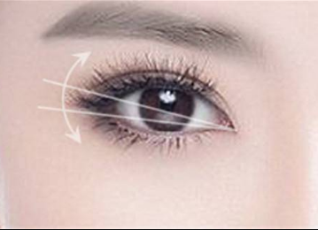 懷化致臻美悅時(shí)尚整形埋線雙眼皮