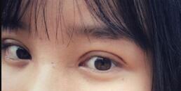 長沙微笑醫(yī)療整形醫(yī)生段雙軍做切開雙眼皮+開內(nèi)眼角效果怎么樣？附案例
