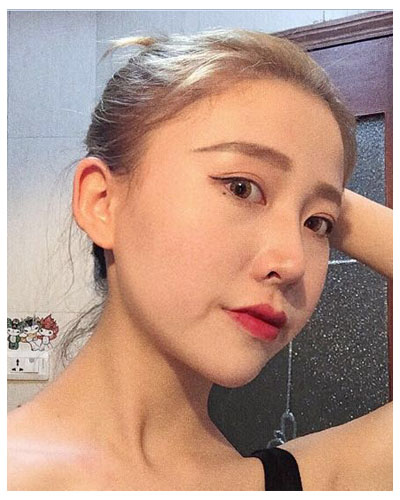 珠海海大整形美容外科黃發(fā)醫(yī)生做面部吸脂怎么樣？附面部吸脂案例