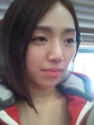 長(zhǎng)春中妍整形醫(yī)院吳學(xué)軍醫(yī)生做玻尿酸墊下巴+玻尿酸豐太陽(yáng)穴案例效果對(duì)比圖 長(zhǎng)春中妍整形醫(yī)院吳學(xué)軍醫(yī)生做玻尿酸墊下巴+玻尿酸豐太陽(yáng)穴案例效果對(duì)比圖