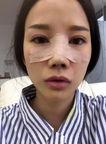 西安陽(yáng)光整形醫(yī)院邵萍醫(yī)生做鼻綜合整形怎么樣？附鼻綜合整形案例