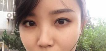 長沙微笑醫(yī)療整形醫(yī)生段雙軍做切開雙眼皮+開內(nèi)眼角效果怎么樣？附案例