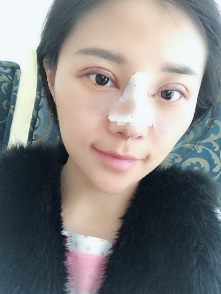 石家莊雅芳亞整形醫(yī)生王文明做雙眼皮+開眼角+鼻綜合整形案例效果對比圖