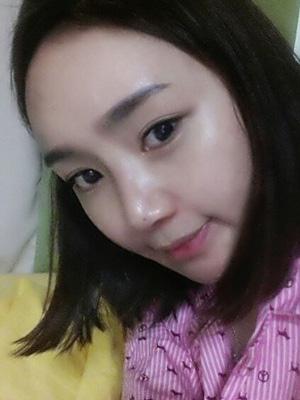 長(zhǎng)春中妍整形醫(yī)院吳學(xué)軍醫(yī)生做玻尿酸墊下巴+玻尿酸豐太陽(yáng)穴案例效果對(duì)比圖 長(zhǎng)春中妍整形醫(yī)院吳學(xué)軍醫(yī)生做玻尿酸墊下巴+玻尿酸豐太陽(yáng)穴案例效果對(duì)比圖